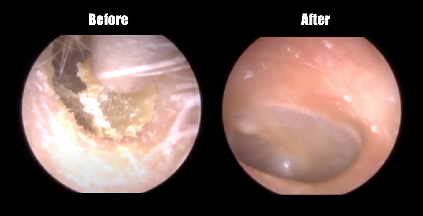 Before and after professional earwax removal and ear cleaning at Ascent Audiology Arizona inside the ear image